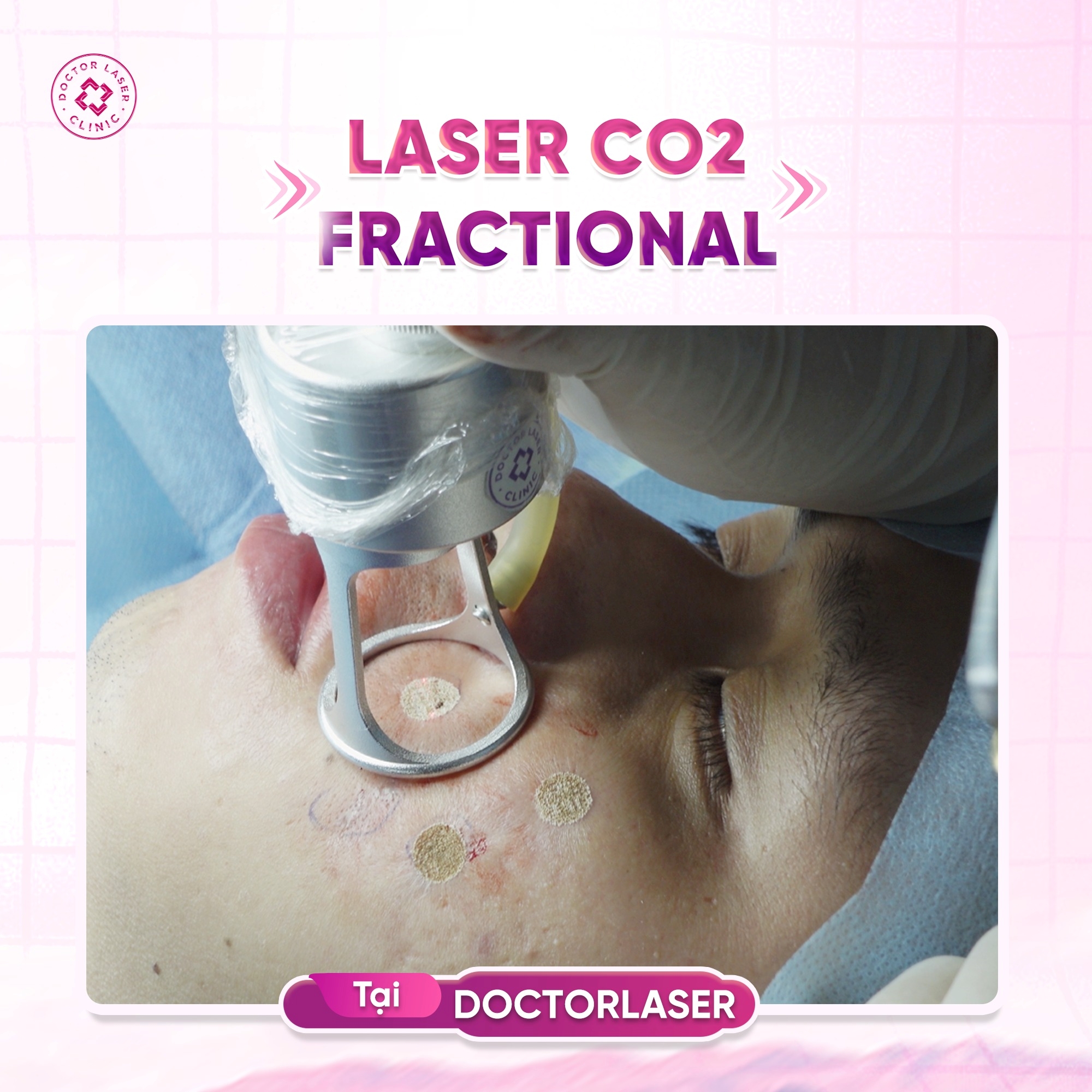 Doctorlaser sử dụng công nghệ laser co2 mới nhất hiện nay